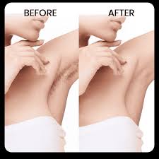 Hair Removal Spray
